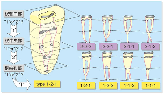 図2-5　根管形態の臨床分類