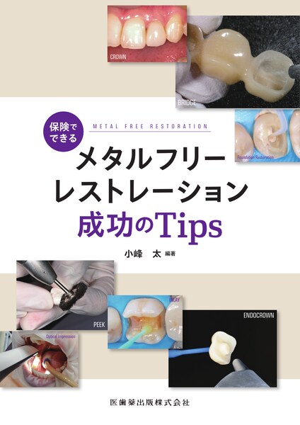 �ی��łł��郁�^���t���[���X�g���[�V����������Tips