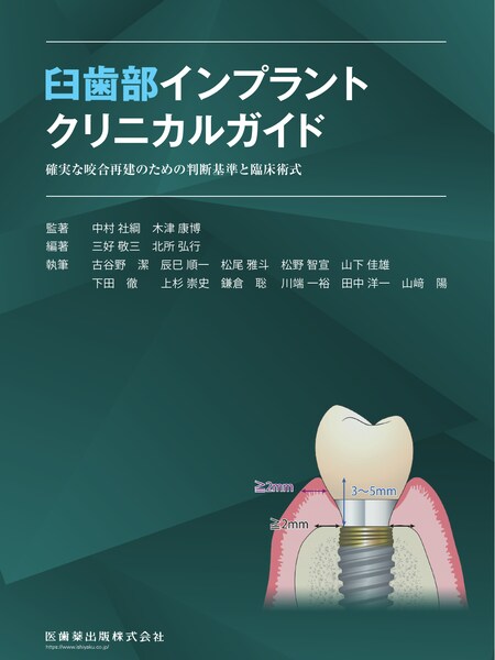 臼歯部インプラントクリニカルガイド
