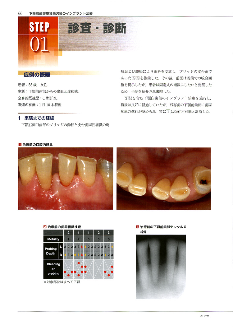 基本症例における IMPLANTS 臨床編／医歯薬出版株式会社