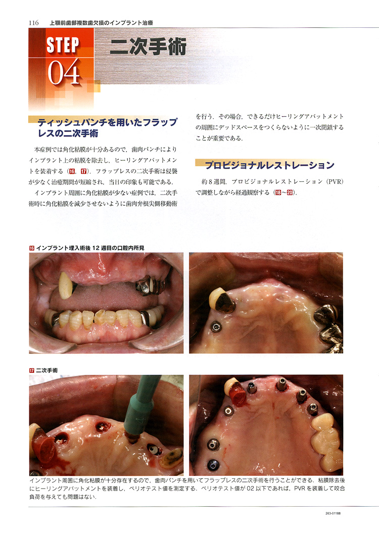 基本症例における IMPLANTS 臨床編／医歯薬出版株式会社